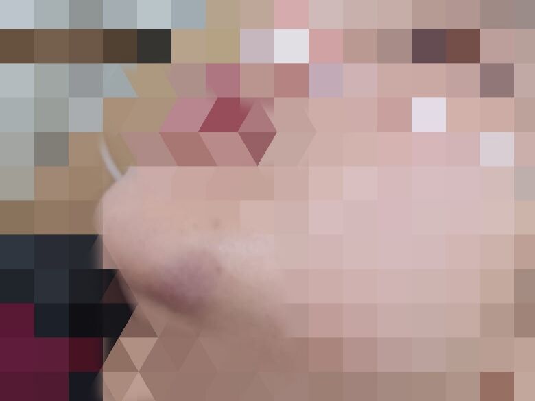 Ilustrasi luka lebam dampak dari KDRT